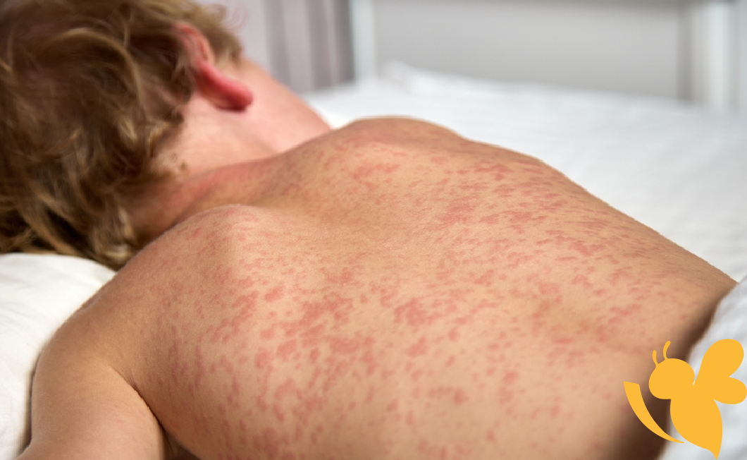 First measles case in Wyoming in 15 years confirmed in Casper