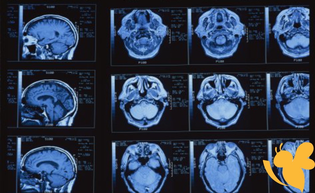 Scientists Use MRI to Decode Brain’s Internal Clock, Predict Dementia Early