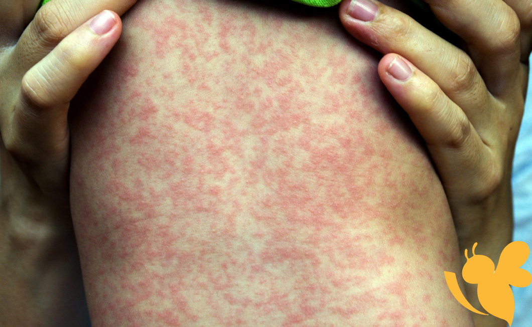 Measles Cases Hit Record High Since U.S. Declared Disease Eliminated