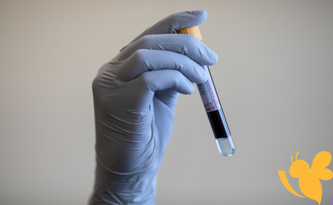 Simple blood test predicts rapid development of severe Alzheimers